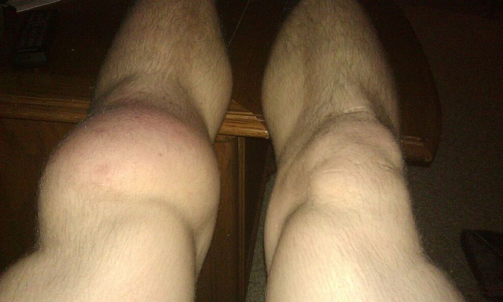 коляно преди лечение с Osteflex